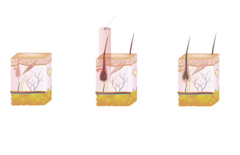 Принцип дії лазерного видалення волосся