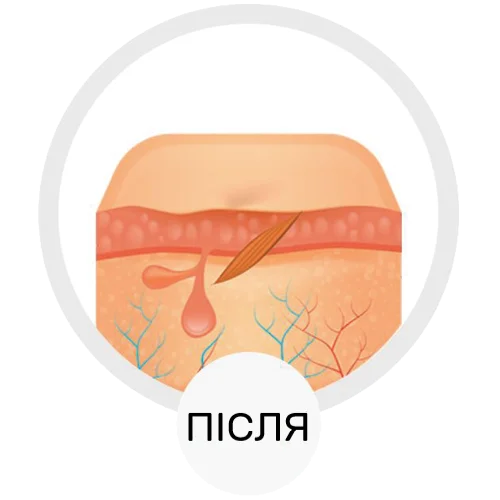 Вплив лазера - після