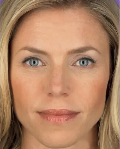 After-mesotherapy-1