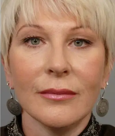After mesotherapy effect After mesotherapy effect