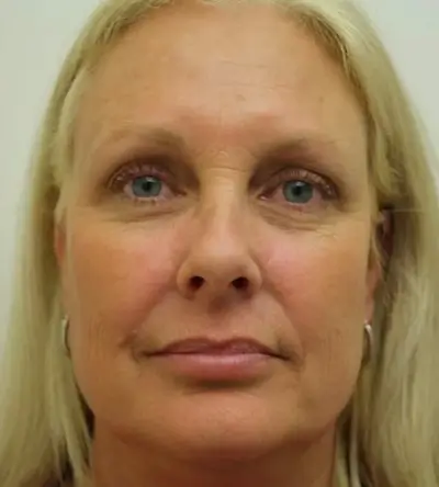 After_mesotherapy-6-1 After mesotherapy effect-3