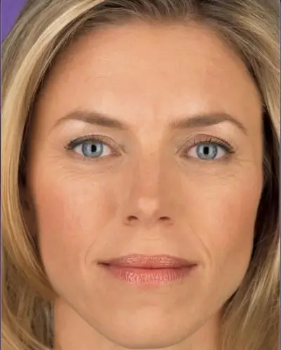 before-mesotherapy3