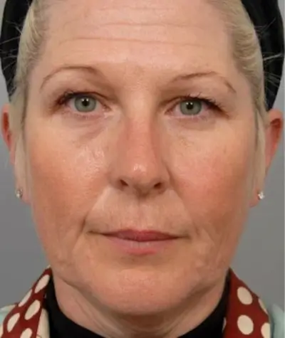 Before mesotherapy effect