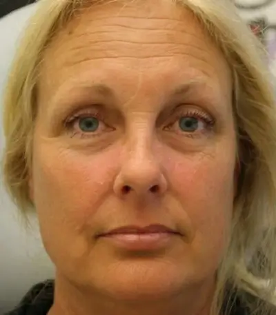 After mesotherapy effect-3