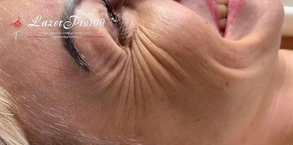 botox- Before