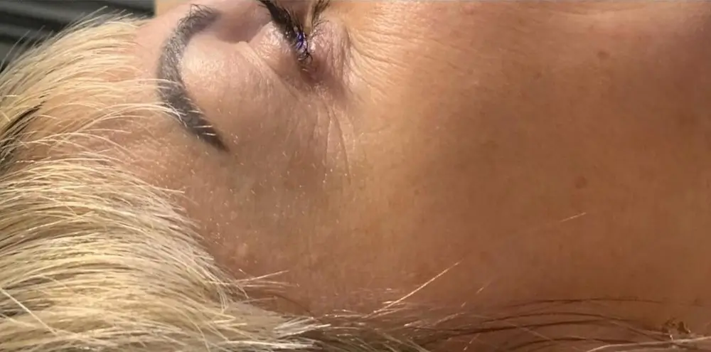 botox- After