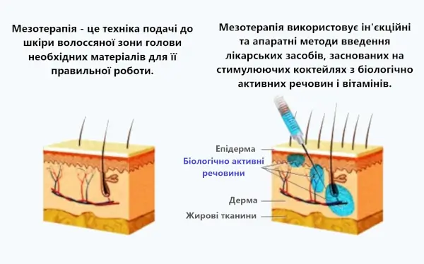принцип дії мезотерапії