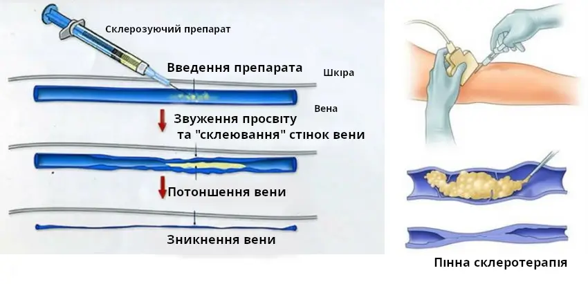 Склеротерапія вен, приним дії